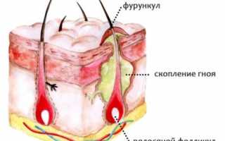 Фурункулы на интимных местах