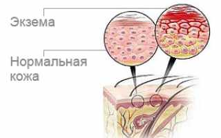 Варикозная экзема на ногах — лечение и профилактика венозной экземы. Экзема варикозы нижних конечностей