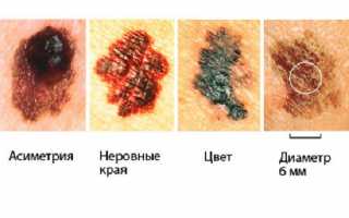 Меланома кожи — лечение, причины  и симптомы болезни
