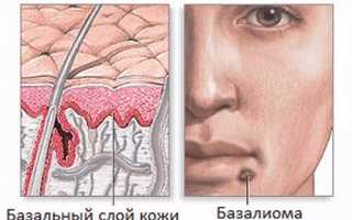 Базалиома после облучения