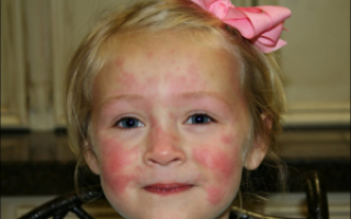Аллергический дерматит у детей — как выглядит и чем лечить