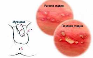 Сыпь на головке причины появления: что нужно  делать?