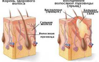 Как убрать угри