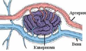 Ангиома головного мозга
