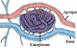 Ангиома головного мозга