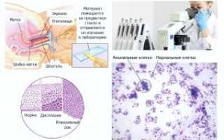 Анализ на вирус папилломы человека (ВПЧ)
