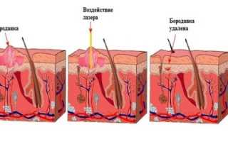 Удаление бородавок лазером