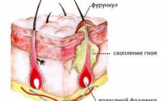 Чтобы фурункул быстрее созрел