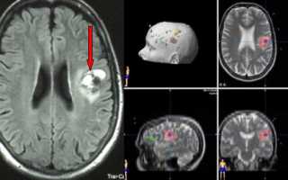Ангиома головного мозга, левой и правой лобной доли